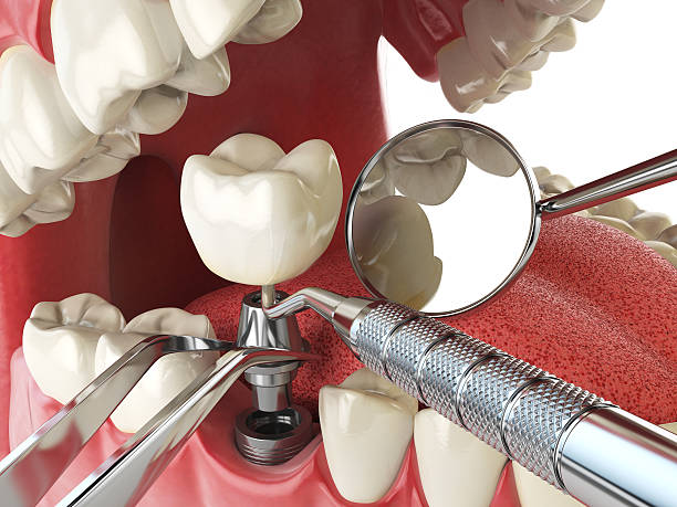 Best Emergency Wisdom Tooth Extraction in Belton, SC