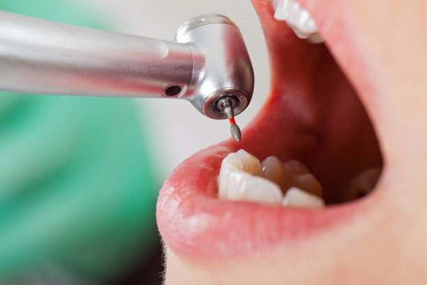 Best Lost Filling or Crown Replacement in Belton, SC